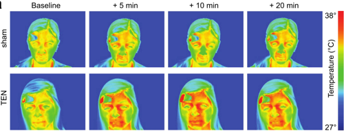 红外热像仪所显示的，TEN显着调节交感皮肤反应和情绪