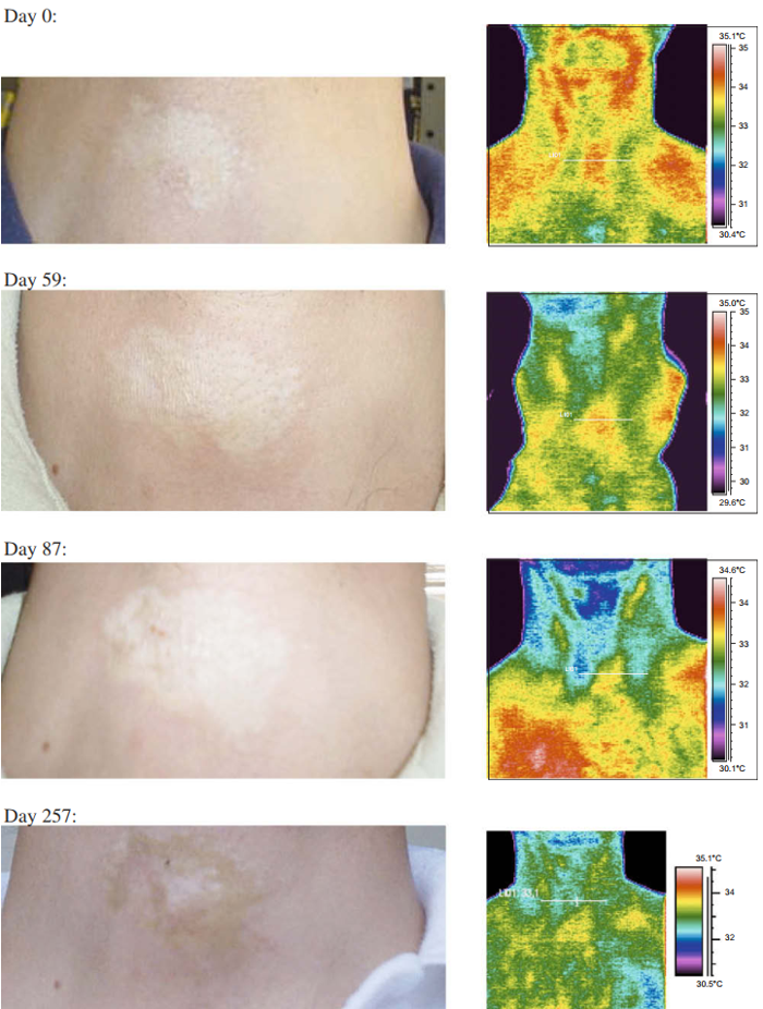 在治疗随访期间，在不同情况下捕获的麻风皮肤病变的实际照片和红外热图像之间的对应关系。从上到下：第0天，第59天，第87天和第257天